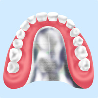 コバルトクロム床義歯・チタン床義歯