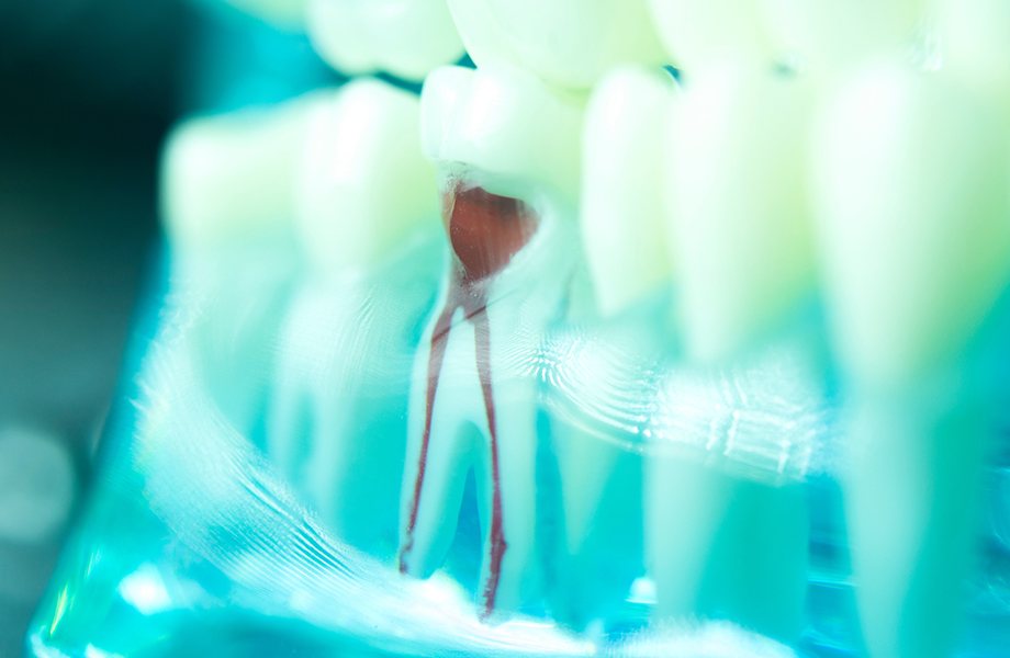 重度の虫歯でも天然歯を残す「根管治療」
